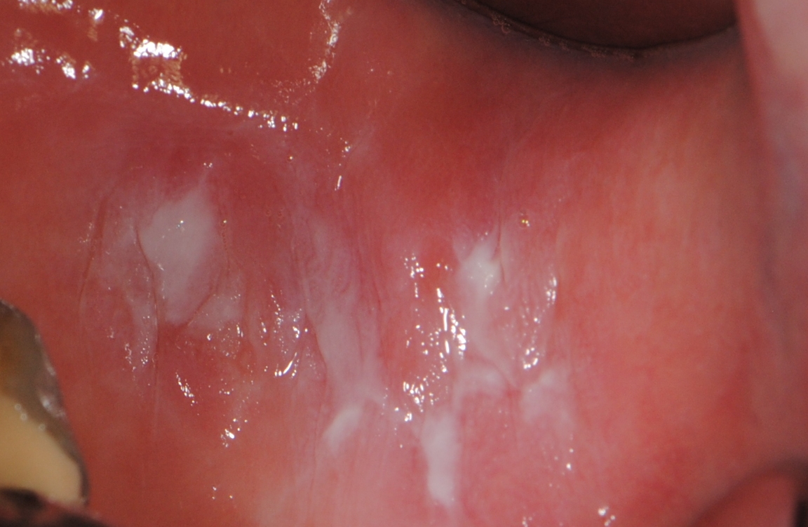 soft-tissue-disease-mouth